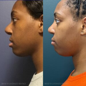 Before and after - Brad M Gandolfi MD Facs