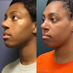 Before and after picture - Brad M Gandolfi MD Facs