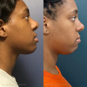Before and after picture - Brad M Gandolfi MD Facs