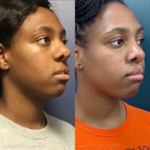 Before and after picture - Brad M Gandolfi MD Facs