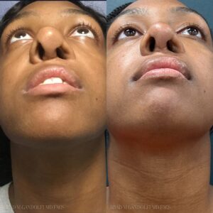 Before and after picture - Brad M Gandolfi MD Facs