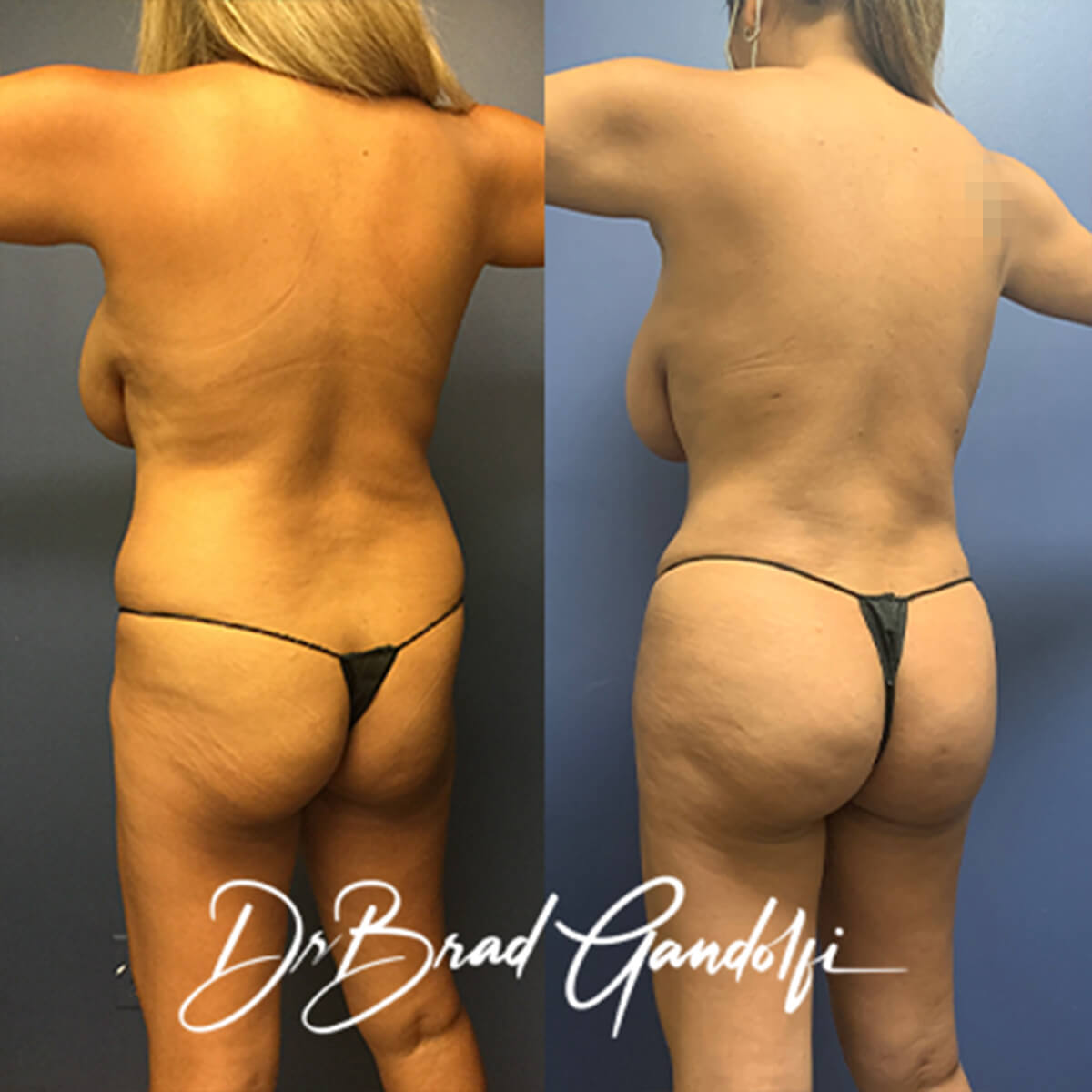 Brazilian Butt Lift NYC, Dr. Brad Gandolfi