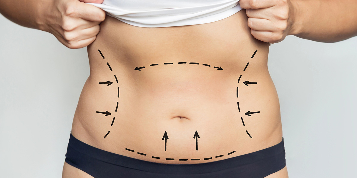 How Long Does A Mommy Makeover Take?